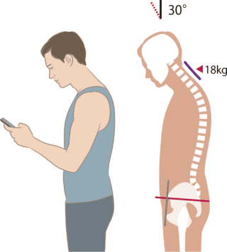 Dolor de cuello por mala postura